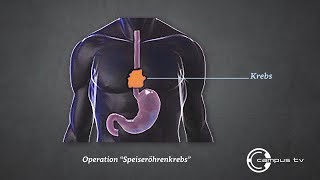 Speiseröhrenkrebs So wird ein Ösophaguskarzinom mit dem OPRoboter minimalinvasiv operiert [upl. by Adnarb698]