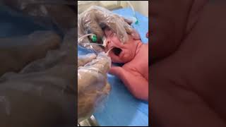 Suction process of newborn for nose and mouth clean bad water [upl. by Bard690]