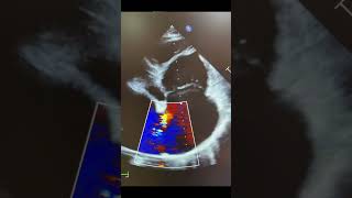 Atrial septal defect in adult [upl. by Kenaz]