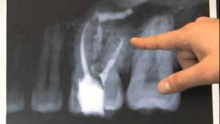 Endodontic Case  Found Calcium Hydroxide [upl. by Moshell111]