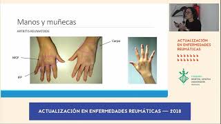 Diferencias clínicas Artrosis versus Artritis Reumatoide [upl. by Convery]