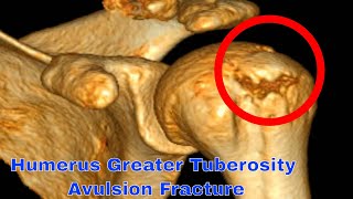 Humerus Greater Tuberosity Avulsion Fracture The Most Painful Fracture Youll Ever Experience [upl. by Lilah]