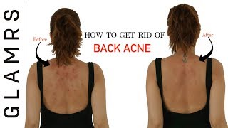 How To Get Rid of Back Acne the Natural Way  Effective Home Remedies [upl. by Ihcego]