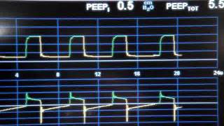 Obtaining a Intrinsic PEEP PEEPi measurement with the PB840 ventilator [upl. by Acemaj]