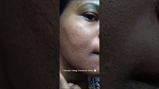 1 Month Using Tretinoin Daily to see the effect viralvideo tretinoin shorts youtubeshorts [upl. by Xed844]