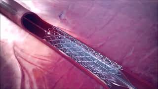 Coronary Aspiration Catheter Animation  Penumbra [upl. by Mor]