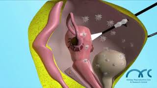 About Endometrium Thickness DrMahalakshmi Saravanan Top Infertility Specialist [upl. by Higgs]