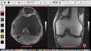 Systematic Interpretation of Knee MRI How I do it [upl. by Nillek]