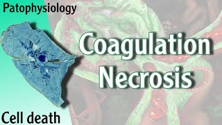 Pathophysiology  Coagulation Necrosis Hani Laith شرح [upl. by Ahsilam349]