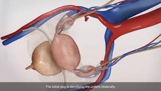 Bronchial Blocker Insertion [upl. by Rachelle]