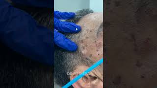 Say goodbye to the unwanted moles skin tags or any lesions  Dr MediSpa [upl. by Mellitz]