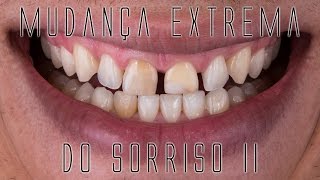 Mudança extrema do sorriso II Os bastidores das facetas e lentes de contato dentais [upl. by Eceirtal]