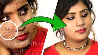 How to remove pimple marks  Home Remedies for Black Spots on Face  Beauty Tips in Tamil [upl. by Ordep]