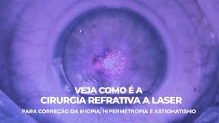 Como é feita a Cirurgia Refrativa a Laser para a correção da Miopia Hipermetropia e Astigmatismo [upl. by Arihaj]