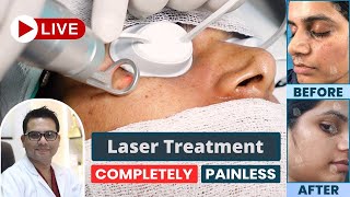 Freckles Laser Treatment  Best Freckles Laser Treatment in Delhi NCR  SkinQure  Dr Jangid [upl. by Latty]