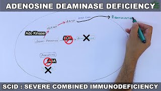 Adenosine Deaminase Deficiency  SCID [upl. by Saraann]