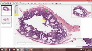 Trichofolliculoma [upl. by Haldane]