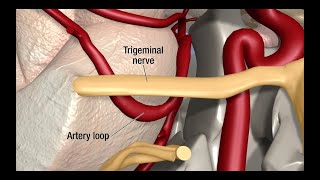 Treatment for Trigeminal Neuralgia UCSF Neurosurgery [upl. by Annahsat]