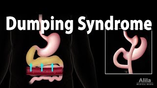 Dumping Syndrome Animation [upl. by Winebaum]