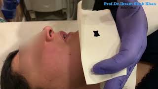 Excimer 308 Lasers Path to Vitiligo Freedom lasertreatment vitiligotreatment [upl. by Jeffry]