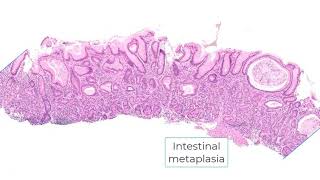 Autoimmune gastritis and differential diagnosis [upl. by Dearman787]