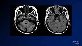 Neuroradiology board review lecture 1 case 19 [upl. by Feld63]