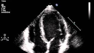 Ecocardiograma Doppler [upl. by Breh]