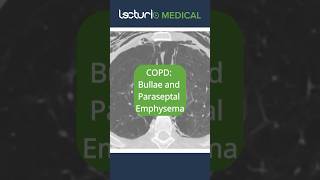 🔍 CT Scan Insights Bullae amp Paraseptal Emphysema EmphysemaInsights RadiologyRevealed usmle [upl. by Tyrone]