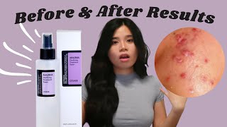 COSRX  1 MONTH REVIEW  RESULTS on ACNE SKIN  AHA BHA Clarifying Treatment Toner [upl. by Hayton]