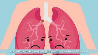 Vídeo 1  ¿Qué es la Fibrosis Quística [upl. by Evilo]