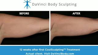 CoolSculpting Arms Treatment Real Before amp After Results [upl. by Hsiwhem]