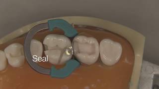 Class II Composite Restoration  Stevenson Dental Solutions [upl. by Hgielah381]