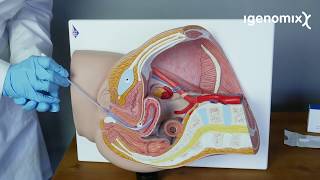 How to perform the endometrial biopsy for Igenomix´s ERA Test [upl. by Nnyl]