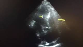 Ecocardiograma de aneurisma de aorta Dr Andre Chiga [upl. by Garth812]