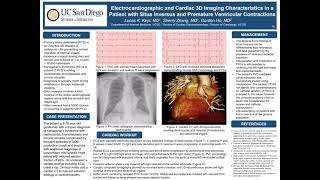 Electrocardiographic and Cardiac 3D Imaging Characteristics in Patient with Situs Inversus and PVCs [upl. by Subir444]