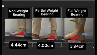 Effect of Weight Bearing on Medial Longitudinal Arch of Foot [upl. by Ellenig636]