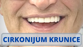 Hollywood smile  Osmeh iz snova  Cirkonijum keramičke krunice na implantatima [upl. by Mudenihc]