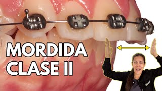 CORRECCIÓN de Mordida Clase 2 con BRACKETS y MINITORNILLOS  quotsiento mis dientes hacia afueraquot [upl. by Basset]