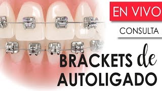 BRACKETS DE AUTOLIGADO  CONSULTORIO VIRTUAL RESOLVIENDO TUS DUDAS [upl. by Namrac]