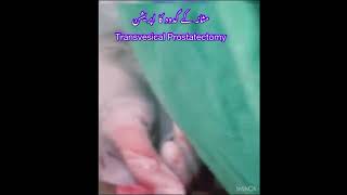 Prostatectomy Operation  Transvesical  Dr QASIM NAWAZ prostatectomy [upl. by Thom]