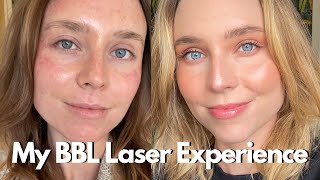 My BBL Laser Experience What You Need To Know BroadBand Light Photofacial [upl. by Vikky]