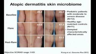 Eczema Immunity and the Skin Microbiome  Heidi Kong [upl. by Purvis]