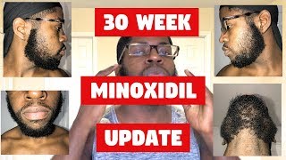 Growing a Beard With Minoxidil A Black Mans Experience Week 30 Steady Progress [upl. by Keefe]