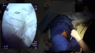 WATCH a Cervical Radiofrequency Ablation  LIVE [upl. by Vinn709]