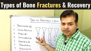 Types of Bone Fractures Open and Closed Fracture Everything you need to know Fracture Healing [upl. by Rednaskela]