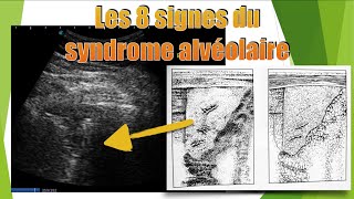 8 aspects de pneumopathie en échographie [upl. by Gilburt102]