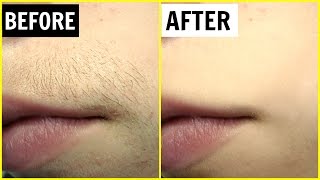 पाएं अनचाहे बालों से छुटकारा  Permanent Hair Removal  Anaysa [upl. by Ahsatin]