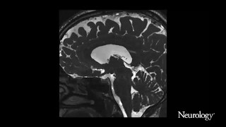 Choroid plexus hyperplasia A possible cause of hydrocephalus in adults [upl. by Ahsilrak]