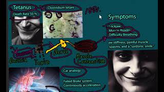 Tetanus Disease Lockjaw  signs and symptoms prevention treatment and prognosis [upl. by Nivlad]