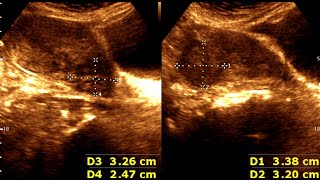 Three cases of Leiomyoma Uterus  Abnormal Uterine Bleeding  sonographic prediction [upl. by Rodrigo370]